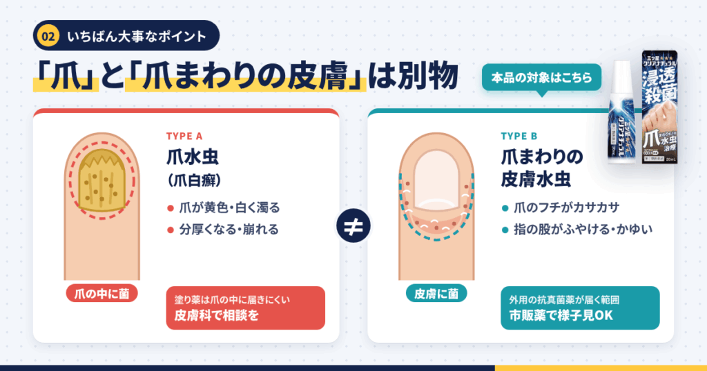 「爪水虫」と「爪まわりの水虫」は別物｜ここを混同すると口コミに振り回される